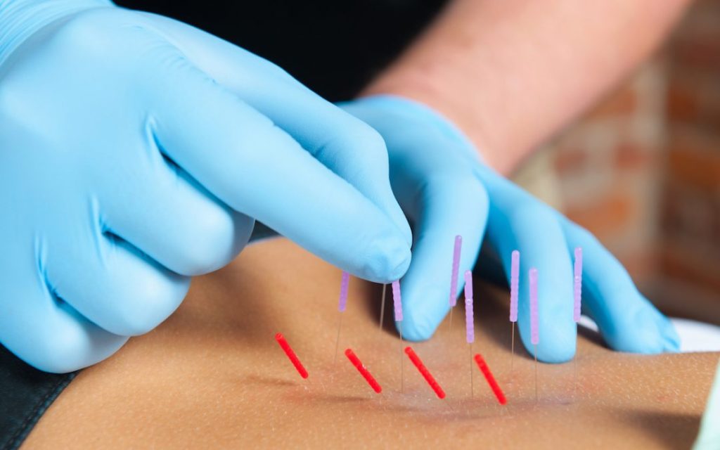 acupuntura, dry needling,agulhamento seco